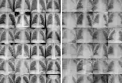 Detecting Pneumonia With Quantum AI